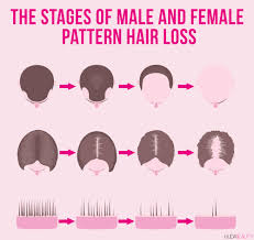 3 Major Causes of Hair Loss