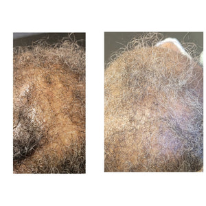 Instant Hair Re Growth Bundle
