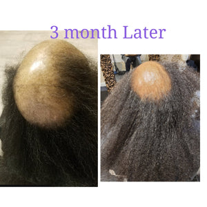 Instant Hair Re Growth Bundle