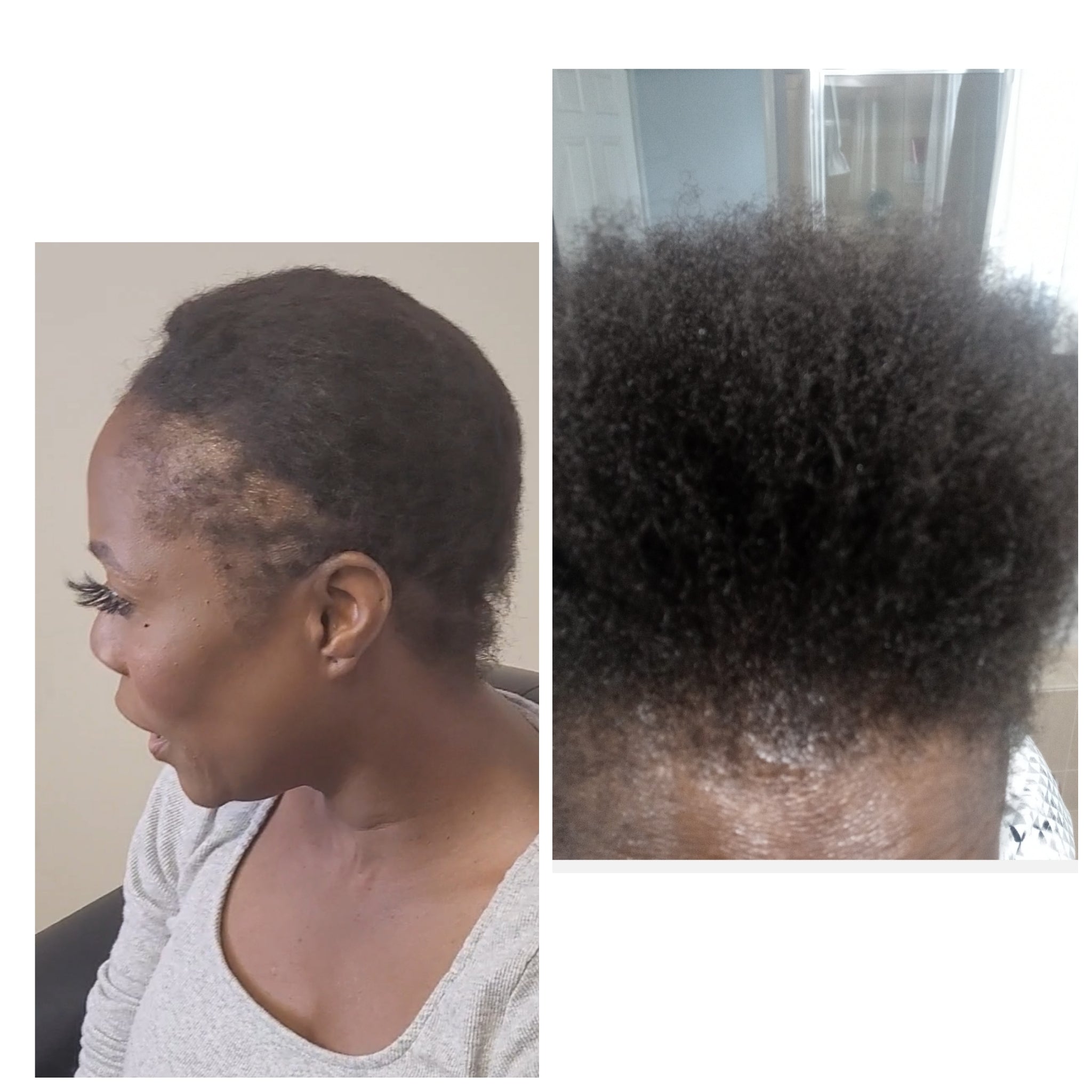 Instant Hair Re Growth Bundle
